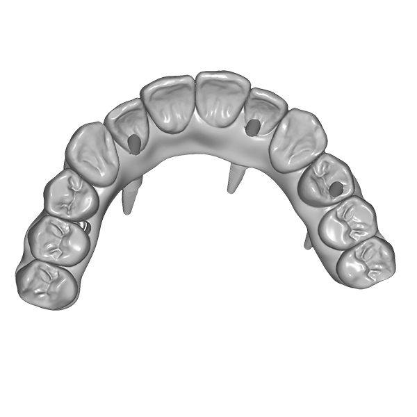 Bridge transvissé sur implant